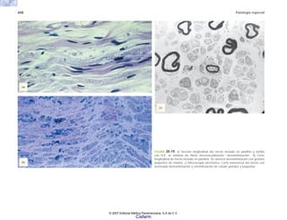 658 Patología especial
FIGURA 20-19. a) Sección longitudinal del nervio incluido en parafina y teñido
con H-E; se exhiben las fibras microvacuolización “desmielinización”. b) Corte
longitudinal de nervio incluido en parafina. Se observa desmielinización con grumos
pequeños de mielina. c) Microscopia electrónica. Corte transversal del nervio con
acentuada desmielinización y remielinización de células grandes y pequeñas.
(c)
(a)
(b)
© 2007 Editorial Médica Panamericana, S.A de C.V.
Cisfarm
 