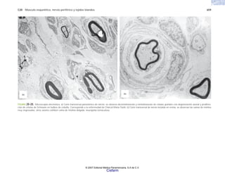 C20 Músculo esquelético, nervio periférico y tejidos blandos 659
FIGURA 20-20. Microscopía electrónica. a) Corte transversal panorámico de nervio; se observa desmielinización y remielinización de células grandes con degeneración axonal y prolifera-
ción de células de Schwann en bulbos de cebolla. Corresponde a la enfermedad de Charcot-Marie-Tooth. b) Corte transversal de nervio incluido en resina; se observan las vainas de mielina
muy engrosadas, otros axones exhiben vaina de mielina delgada; neuropatía tomaculosa.
(a) (b)
© 2007 Editorial Médica Panamericana, S.A de C.V.
Cisfarm
 