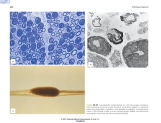 660 Patología especial
FIGURA 20-21. Leucodistrofia metacromática. a) y b) Microscopia electrónica.
Corte transversal de nervio incluido en resina. Se observan axones con vainas de
mielina muy engrosadas y nodulares y otras delgadas e irregulares: neuropatía toma-
culosa. c) Fibra aislada incluida en resina exhibe la mielina nodular, característica de
la neuropatía tomaculosa (del latín tomaculum salchiiha).
(a)
(b)
(c)
© 2007 Editorial Médica Panamericana, S.A de C.V.
Cisfarm
 