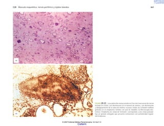 C20 Músculo esquelético, nervio periférico y tejidos blandos 661
FIGURA 20-22. Leucodistrofia metacromática a) Sección transversal de nervio
incluido en resina, con disminución en el número de axones, con disminución
y adelgazamiento de la vaina de mielina; escasas células de Schwann exhiben
gránulos en el citoplasma, teñidos con azul de toluidina. b) Microscopía elec-
trónica. Citoplasma de célula de Schwann; corresponde a una célula granular;
hay un gránulo elongado que presenta estriaciones con periodicidad regular;
electrodensas.
(b)
(a)
© 2007 Editorial Médica Panamericana, S.A de C.V.
Cisfarm
 