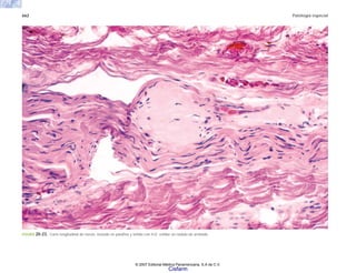 662 Patología especial
FIGURA 20-23. Corte longitudinal de nervio, incluido en parafina y teñido con H-E; exhibe un nódulo de amiloide.
© 2007 Editorial Médica Panamericana, S.A de C.V.
Cisfarm
 
