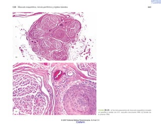 C20 Músculo esquelético, nervio periférico y tejidos blandos 663
FIGURA 20-24. a) Sección panorámica de músculo esquelético incluido
en parafina y teñida con H-E; vasculitis necrosante PAN. b) Detalle de
la anterior PAN.
(b)
(a)
© 2007 Editorial Médica Panamericana, S.A de C.V.
Cisfarm
 