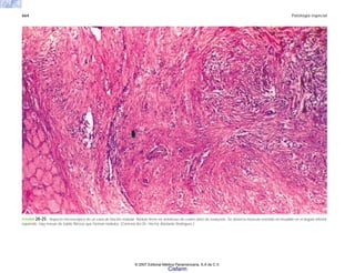 664 Patología especial
FIGURA 20-25. Aspecto microscópico de un caso de fascitis nodular. Nódulo firme en antebrazo de cuatro años de evolución. Se observa músculo estriado no invadido en el ángulo inferior
izquierdo. Hay masas de tejido fibroso que forman nódulos. (Cortesía del Dr. Héctor Abelardo Rodríguez.)
© 2007 Editorial Médica Panamericana, S.A de C.V.
Cisfarm
 