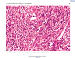 C20 Músculo esquelético, nervio periférico y tejidos blandos 665
FIGURA 20-26. Histología de un fibrosarcoma, formado por haces de células alargadas con núcleos puntiagudos; hay varias mitosis. (Cortesía del Dr. Héctor Abelardo Rodríguez.)
© 2007 Editorial Médica Panamericana, S.A de C.V.
Cisfarm
 