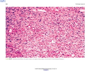 666 Patología especial
FIGURA 20-27. Fibrohistiocitoma fibroso, de carácter celular y con algunas células atípicas. (Cortesía del Dr. Héctor Abelardo Rodríguez.)
© 2007 Editorial Médica Panamericana, S.A de C.V.
Cisfarm
 