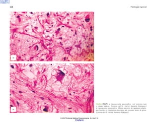 668 Patología especial
FIGURA 20-29. a) Liposarcoma pleomórfico, con estroma laxo
y células atípicas. (Cortesía del Dr. Héctor Abelardo Rodríguez.)
b) Liposarcoma pleomórfico. Mayor aumento de lipoblasto atípico,
que muestra el citoplasma distendido por vacuolas llenas de grasa.
(Cortesía del Dr. Héctor Abelardo Rodríguez.)
(a)
(b)
© 2007 Editorial Médica Panamericana, S.A de C.V.
Cisfarm
 