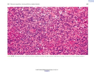 C20 Músculo esquelético, nervio periférico y tejidos blandos 669
FIGURA 20-30. Mesenquimoma, que muestra dos elementos neoplásicos derivados del tejido conjuntivo: tejido fibroso y cartílago. (Cortesía del Dr. Héctor Abelardo Rodríguez.)
© 2007 Editorial Médica Panamericana, S.A de C.V.
Cisfarm
 