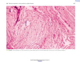C20 Músculo esquelético, nervio periférico y tejidos blandos 671
FIGURA 20-32. Sarcoma epiteloide, en el que una parte de las células adopta aspecto de carcinoma epidermoide. (Cortesía del Dr. Héctor Abelardo Rodríguez.)
© 2007 Editorial Médica Panamericana, S.A de C.V.
Cisfarm
 