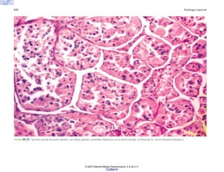 672 Patología especial
FIGURA 20-33. Sarcoma alveolar de partes blandas, con células grandes, eosinófilas dispuestas en un patrón alveolar. (Cortesía del Dr. Héctor Abelardo Rodríguez.)
© 2007 Editorial Médica Panamericana, S.A de C.V.
Cisfarm
 