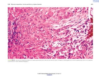 C20 Músculo esquelético, nervio periférico y tejidos blandos 673
FIGURA 20-34. Sarcoma de Ewing desarrollado en la región paravertebral de un niño de ocho años de edad. La imagen es indistinguible de la misma neoplasia que ocurre en el esqueleto.
(Cortesía del Dr. Héctor Abelardo Rodríguez.)
© 2007 Editorial Médica Panamericana, S.A de C.V.
Cisfarm
 