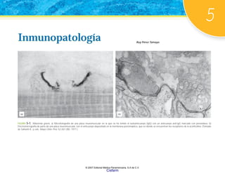 5
Inmunopatología Ruy Pérez Tamayo
Inmunopatología
FIGURA 5-1. Miastenia gravis. a) Microfotografía de una placa neuromuscular en la que se ha teñido el autoanticuerpo (IgG) con un anticuerpo anti-IgG marcado con peroxidasa. b)
Electromicrografía de parte de una placa neuromuscular, con el anticuerpo depositado en la membrana postsináptica, que es donde se encuentran los receptores de la acetilcolina. (Tomado
de Sahashi K, y cols. Mayo Clinic Proc 52:267-280. 1977.)
(b)
(a)
© 2007 Editorial Médica Panamericana, S.A de C.V.
Cisfarm
 