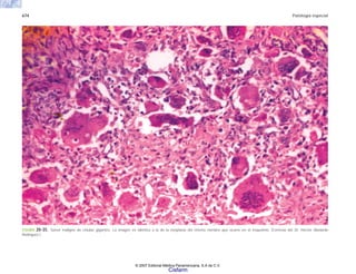 674 Patología especial
FIGURA 20-35. Tumor maligno de células gigantes. La imagen es idéntica a la de la neoplasia del mismo nombre que ocurre en el esqueleto. (Cortesía del Dr. Héctor Abelardo
Rodríguez.)
© 2007 Editorial Médica Panamericana, S.A de C.V.
Cisfarm
 
