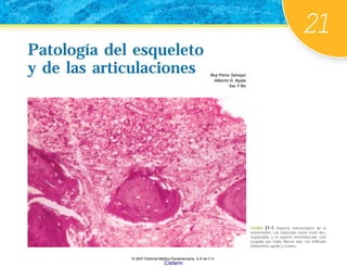 21
Patología del esqueleto
y de las articulaciones Ruy Pérez Tamayo
Alberto G. Ayala
Yae Y Ro
Patología del esqueleto
y de las articulaciones
FIGURA 21-1. Aspecto microscópico de la
osteomielitis. Las trabéculas óseas están des-
organizadas y el espacio intertrabecular está
ocupado por tejido fibroso laxo con infiltrado
inflamatorio agudo y crónico.
© 2007 Editorial Médica Panamericana, S.A de C.V.
Cisfarm
 