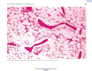 C21 Patología del esqueleto y de las articulaciones 689
FIGURA 21-3. Osteoporosis. Las trabéculas óseas son muy delgadas y están separadas entre sí por espacios amplios.
© 2007 Editorial Médica Panamericana, S.A de C.V.
Cisfarm
 