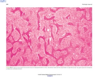 690 Patología especial
FIGURA 21-4. Aspecto microscópico de una lesión ósea en el hiperparatiroidismo crónico. Abundantes trabéculas finas depositadas en tejido fibroso laxo; hay signos aparentes de depósito
y reabsorción acelerada del hueso.
© 2007 Editorial Médica Panamericana, S.A de C.V.
Cisfarm
 