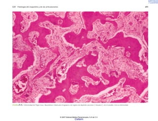 C21 Patología del esqueleto y de las articulaciones 691
FIGURA 21-5. Enfermedad de Paget ósea. Abundantes trabéculas irregulares con signos de depósito excesivo (“mosaico”), en el estadio 2 de la enfermedad.
© 2007 Editorial Médica Panamericana, S.A de C.V.
Cisfarm
 
