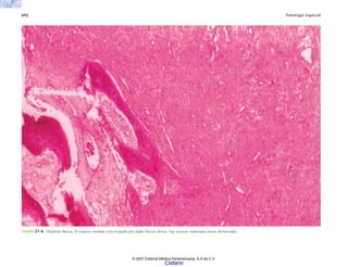 692 Patología especial
FIGURA 21-6. Displasia fibrosa. El espacio medular está ocupado por tejido fibroso denso; hay escasas trabéculas óseas deformadas.
© 2007 Editorial Médica Panamericana, S.A de C.V.
Cisfarm
 