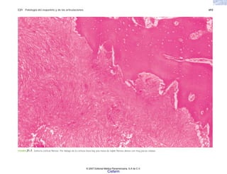 C21 Patología del esqueleto y de las articulaciones 693
FIGURA 21-7. Defecto cortical fibroso. Por debajo de la corteza ósea hay una masa de tejido fibroso denso con muy pocas células.
© 2007 Editorial Médica Panamericana, S.A de C.V.
Cisfarm
 