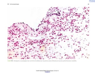 C5 Inmunopatología 65
FIGURA 5-3. Histología de un pseudopólipo nasal, una forma de anafilaxia local; hay edema y densa infiltración por leucocitos polimorfonucleares eosinófilos.
© 2007 Editorial Médica Panamericana, S.A de C.V.
Cisfarm
 