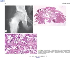 694 Patología especial
FIGURA 21-8. Osteoma osteoide. a) Imagen radiológica de un caso localizado en la apófi-
sis tuberosa del cuello del fémur. b) Pequeño aumento de la neoplasia, que ilustra el nido
rodeado por hueso proliferado no tumoral. c) Mayor aumento del tumor, con abundante
formación de osteoide.
(c)
(b)
(a)
© 2007 Editorial Médica Panamericana, S.A de C.V.
Cisfarm
 