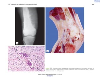 C21 Patología del esqueleto y de las articulaciones 695
FIGURA 21-9. Osteosarcoma. a) Radiografía de un sarcoma osteogénico en la metáfisis del fémur. b)
Aspecto macroscópico de la neoplasia. c) Existe proliferación celular con numerosas atipias y depósito
de tejido osteoide, con calificación focal.
(c)
(b)
(a)
© 2007 Editorial Médica Panamericana, S.A de C.V.
Cisfarm
 