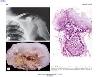 696 Patología especial
FIGURA 21-10. Osteocondroma. a) La neoplasia está localizada en la metáfisis del húme-
ro y muestra un aspecto esponjoso característico. b) Aspecto macroscópico de los dos
componentes del tumor: el cartílago periférico y el tejido óseo central. c) Histología del
osteocondroma.
(a)
(b)
(c)
© 2007 Editorial Médica Panamericana, S.A de C.V.
Cisfarm
 
