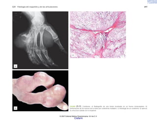 C21 Patología del esqueleto y de las articulaciones 697
FIGURA 21-11. Condroma. a) Radiografía de una lesión localizada en un hueso metacarpiano. b)
Deformación de los huesos de la mano por condromas múltiples. c) Histología de un condroma; se aprecia
la estructura nodular de la neoplasia.
(a)
(b)
(c)
© 2007 Editorial Médica Panamericana, S.A de C.V.
Cisfarm
 