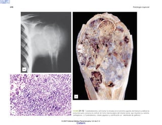 698 Patología especial
FIGURA 21-12. Condroblastoma. a) El tumor se localiza en el extremo superior del húmero y oblitera la
estructura pero conserva la cortical. b) Corte macroscópico del mismo tumor, que muestra su carácter
cartilaginoso. c) Condroblastos, células gigantes y calcificación en “alambrado de gallinero.”
(a)
(c)
(b)
© 2007 Editorial Médica Panamericana, S.A de C.V.
Cisfarm
 