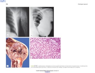700 Patología especial
FIGURA 21-14. Condrosarcoma. a) Neoplasia en el tercio superior del húmero. b) Gran tumor en la pared costal. c) Condrosarcoma
en la extremidad inferior del fémur; se aprecia la formación de cartílago. d) Imagen microscópica de la neoplasia.
(a) (b)
(c)
(d)
© 2007 Editorial Médica Panamericana, S.A de C.V.
Cisfarm
 