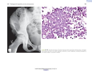 C21 Patología del esqueleto y de las articulaciones 701
FIGURA 21-15. Sarcoma de Ewing. a) Extensa lesión que afecta gran parte del hueso ilíaco. b) Imagen
microscópica del tumor, con células redondas y uniformes, escaso citoplasma, cromatina homogénea y
sin nucleolo visibles; el estroma es mínimo.
(b)
(a)
© 2007 Editorial Médica Panamericana, S.A de C.V.
Cisfarm
 
