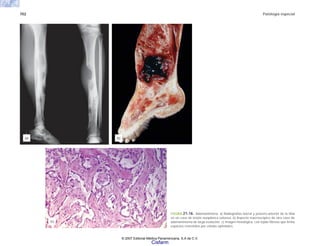 702 Patología especial
FIGURA 21-16. Adamantinoma. a) Radiografías lateral y póstero-anterior de la tibia
en un caso de lesión neoplásica extensa. b) Aspecto macroscópico de otro caso de
adamantinoma de larga evolución. c) Imagen histológica, con tejido fibroso que limita
espacios revestidos por células epiteliales.
(a) (b)
(c)
© 2007 Editorial Médica Panamericana, S.A de C.V.
Cisfarm
 