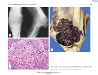 C21 Patología del esqueleto y de las articulaciones 703
FIGURA 21-17. Tumor de células gigantes. a) Radiografías frontal y lateral de la rodilla,
localización clásica de este tumor. b) Destrucción completa de la porción distal del fémur. c)
Histología de la neoplasia, que muestra numerosas células gigantes.
(a)
(b)
(c)
© 2007 Editorial Médica Panamericana, S.A de C.V.
Cisfarm
 