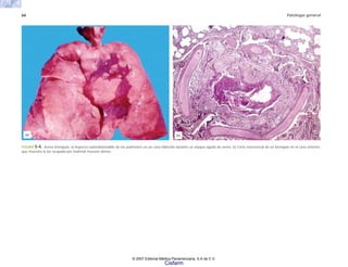 66 Patología general
FIGURA 5-4. Asma bronquial. a) Aspecto sobredistendido de los pulmones en un caso fallecido durante un ataque agudo de asma. b) Corte trasnversal de un bronquio en el caso anterior,
que muestra la luz ocupada por material mucoso denso.
(b)
(a)
© 2007 Editorial Médica Panamericana, S.A de C.V.
Cisfarm
 