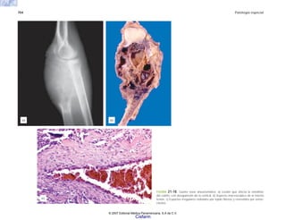 704 Patología especial
FIGURA 21-18. Quiste óseo aneurismático. a) Lesión que afecta la metáfisis
del cúbito, con desaparición de la cortical. b) Aspecto macroscópico de la misma
lesión. c) Espacios irregulares rodeados por tejido fibroso y revestidos por osteo-
clastos.
(a) (b)
(c)
© 2007 Editorial Médica Panamericana, S.A de C.V.
Cisfarm
 