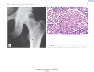 C21 Patología del esqueleto y de las articulaciones 705
FIGURA 21-19. Granuloma eosinófilo. a) Lesión en sacabocado en la base de la cabeza del
fémur sin reacción laminada. b) Acúmulos de células histiocíticas con escasos eosinófilos.
(a)
(b)
© 2007 Editorial Médica Panamericana, S.A de C.V.
Cisfarm
 