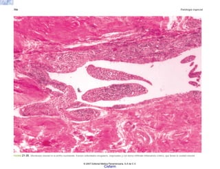 706 Patología especial
FIGURA 21-20. Membrana sinovial en la artritis reumatoide. Existen vellosidades irregulares, engrosadas y con denso infiltrado inflamatorio crónico, que llenan la cavidad sinovial.
© 2007 Editorial Médica Panamericana, S.A de C.V.
Cisfarm
 