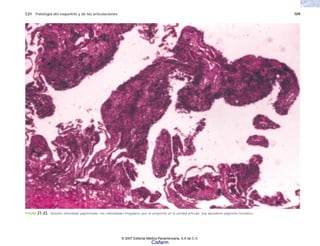 C21 Patología del esqueleto y de las articulaciones 709
FIGURA 21-23. Sinovitis vilonodular pigmentada, con vellosidades irregulares que se proyectan en la cavidad articular; hay abundante pigmento hemático.
© 2007 Editorial Médica Panamericana, S.A de C.V.
Cisfarm
 
