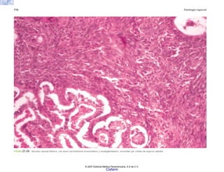 710 Patología especial
FIGURA 21-24. Sarcoma sinovial bifásico, con áreas sarcomatosas fusocelulares y seudoglandulares, revestidas por células de aspecto epitelial.
© 2007 Editorial Médica Panamericana, S.A de C.V.
Cisfarm
 