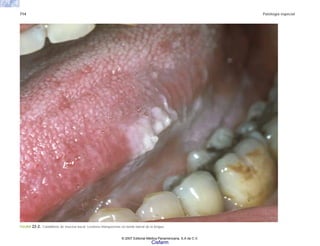 714 Patología especial
FIGURA 22-2. Candidiasis de mucosa bucal. Lesiones blanquecinas en borde lateral de la lengua.
© 2007 Editorial Médica Panamericana, S.A de C.V.
Cisfarm
 