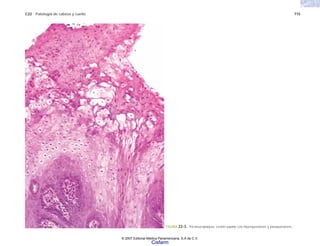 C22 Patología de cabeza y cuello 715
FIGURA 22-3. Tricoleucoplaquia. Lesión papilar con hiperqueratosis y paraqueratosis.
© 2007 Editorial Médica Panamericana, S.A de C.V.
Cisfarm
 