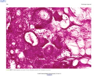 716 Patología especial
FIGURA 22-4. Sialometaplasia necrosante. Ácinos infartados y ductos con metaplasia escamosa.
© 2007 Editorial Médica Panamericana, S.A de C.V.
Cisfarm
 