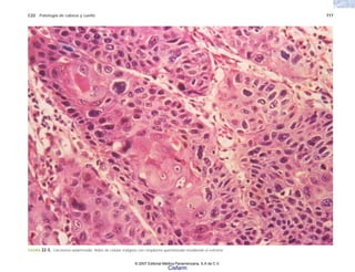 C22 Patología de cabeza y cuello 717
FIGURA 22-5. Carcinoma epidermoide. Nidos de células malignas con citoplasma queratinizado invadiendo el estroma.
© 2007 Editorial Médica Panamericana, S.A de C.V.
Cisfarm
 