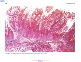 718 Patología especial
FIGURA 22-6. Carcinoma verrugoso. Lesión exofítica bien queratinizada con margen profundo bien circunscrito.
© 2007 Editorial Médica Panamericana, S.A de C.V.
Cisfarm
 