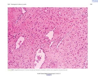 C22 Patología de cabeza y cuello 719
FIGURA 22-7. Angiofibroma juvenil. El estroma formado por fibroblastos inmaduros contiene vasos sanguíneos sin pared muscular.
© 2007 Editorial Médica Panamericana, S.A de C.V.
Cisfarm
 