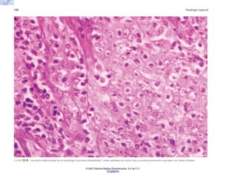 720 Patología especial
FIGURA 22-8. Carcinoma indiferenciado de la nasofaringe (carcinoma linfoepitelial). Células epiteliales de núcleo claro y nucleolo prominente mezcladas con células linfoides.
© 2007 Editorial Médica Panamericana, S.A de C.V.
Cisfarm
 