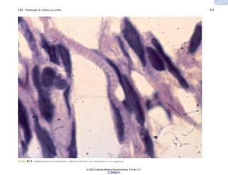C22 Patología de cabeza y cuello 721
FIGURA 22-9. Rabdomiosarcoma embrionario. Células fusiformes con estriaciones en el citoplasma.
© 2007 Editorial Médica Panamericana, S.A de C.V.
Cisfarm
 