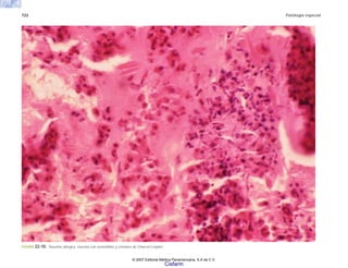 722 Patología especial
FIGURA 22-10. Sinusitis alérgica. mucina con eosinófilos y cristales de Charcot-Leyden
© 2007 Editorial Médica Panamericana, S.A de C.V.
Cisfarm
 