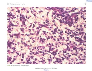 C22 Patología de cabeza y cuello 723
FIGURA 22-11. Rinoscleroma. Células de Mikulicz.
© 2007 Editorial Médica Panamericana, S.A de C.V.
Cisfarm
 