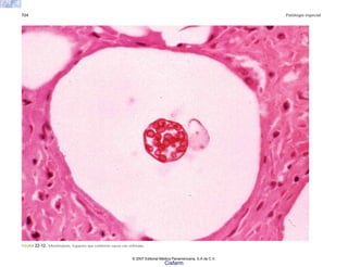 724 Patología especial
FIGURA 22-12. Miosferulosis. Espacios que contienen sacos con esférulas.
© 2007 Editorial Médica Panamericana, S.A de C.V.
Cisfarm
 