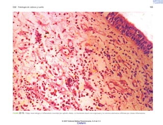 C22 Patología de cabeza y cuello 725
FIGURA 22-13. Pólipo nasal alérgico o inflamatorio revestido por epitelio ciliado. La membrana basal está engrosada y la estroma edematosa infiltrada por células inflamatorias.
© 2007 Editorial Médica Panamericana, S.A de C.V.
Cisfarm
 